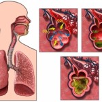 Bacterial Pneumonia – Symptoms, Treatments and Prevention
