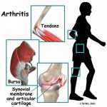 Is It Really Arthritis?