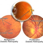 Diabetic Eye Disease