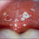Effective Remedies to treat Thrush