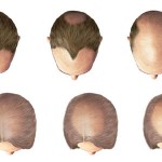 Hair loss: Major signs and symptoms